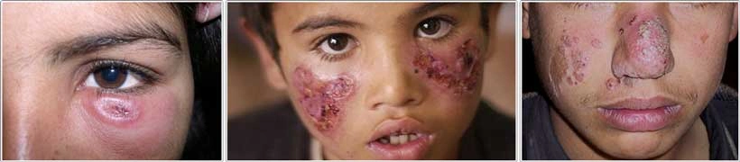 تصاویر بیماری سالک از محل گزیدگی